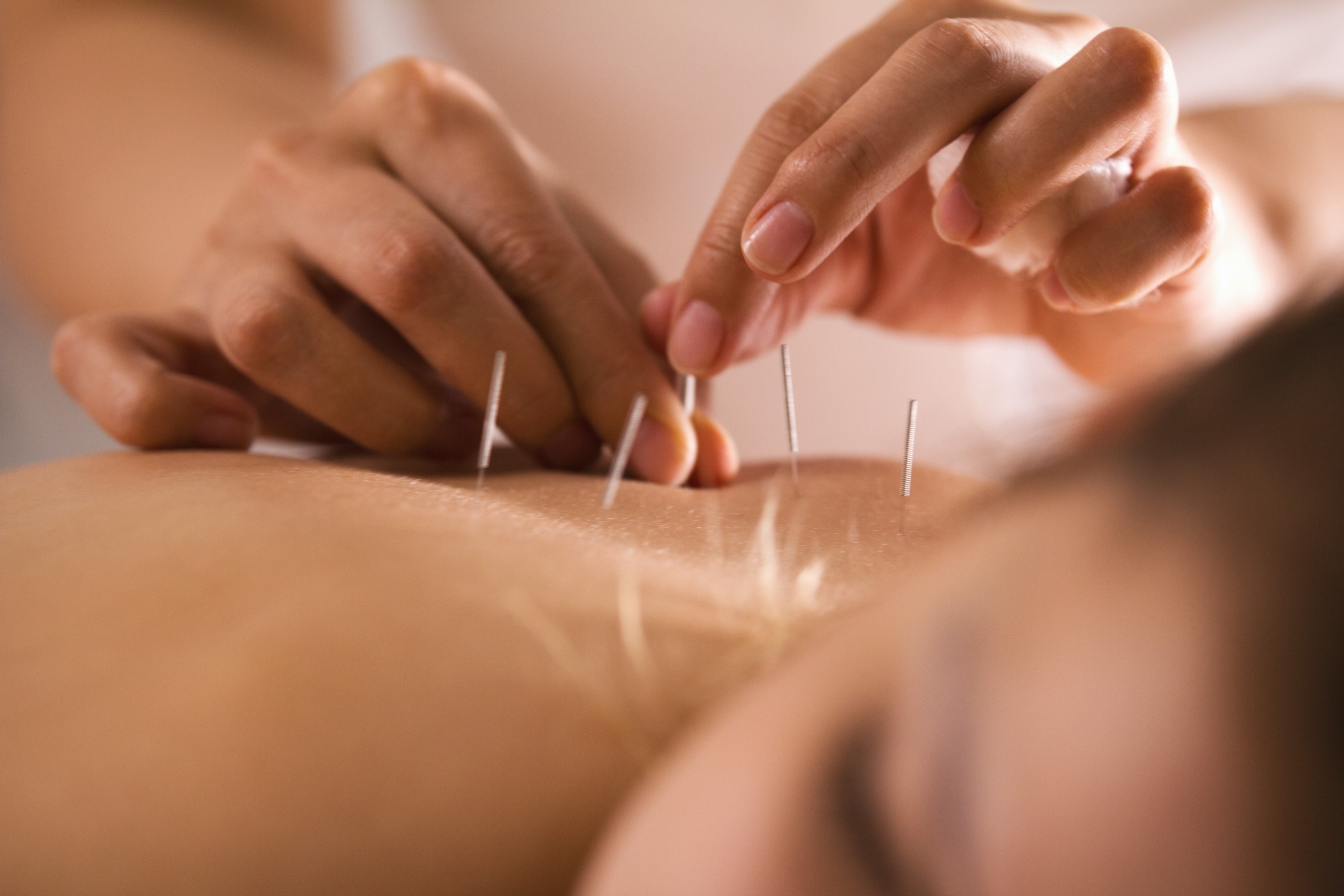 Close up of a woman in an acupuncture session